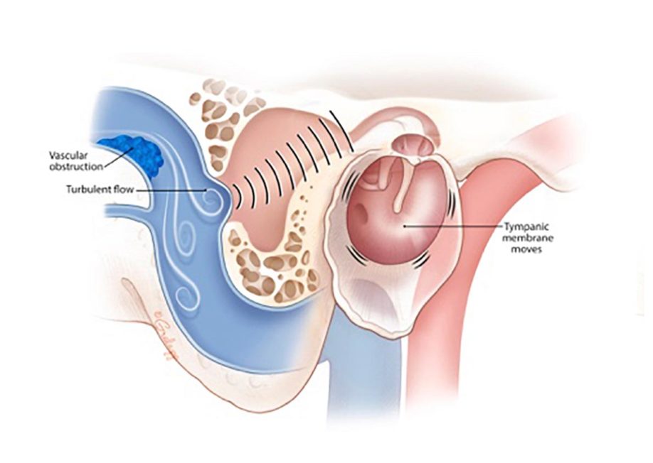 Pulsatile tinnitus.