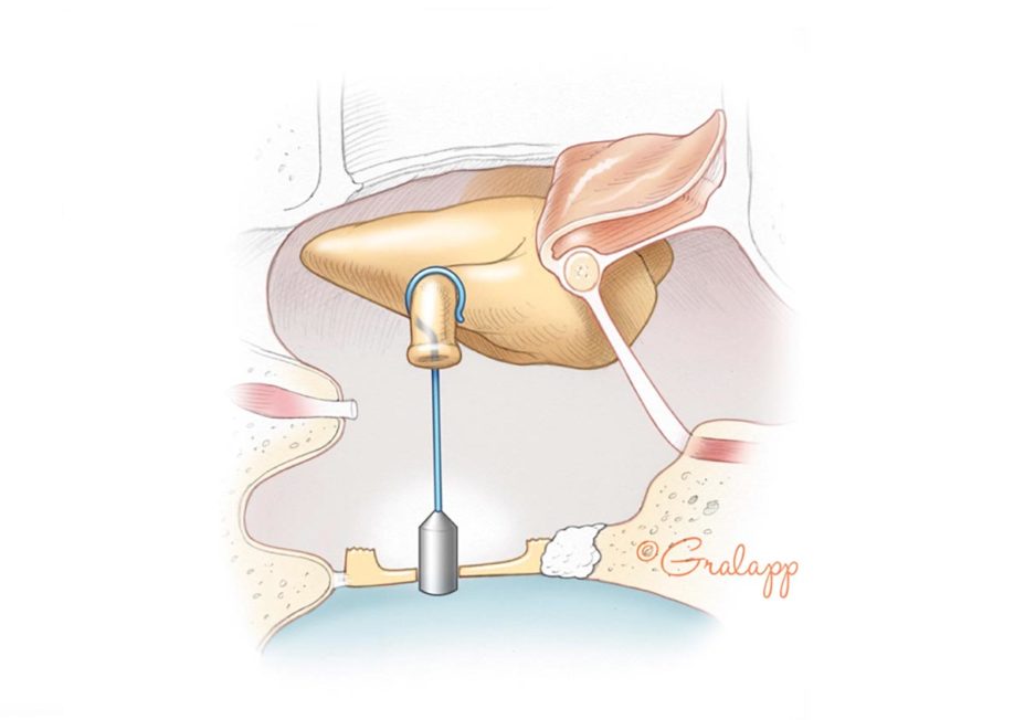 Otosclerosis and stapes surgery.