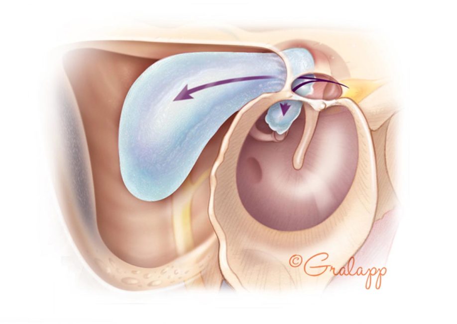 Cholesteatoma and mastoidectomy.