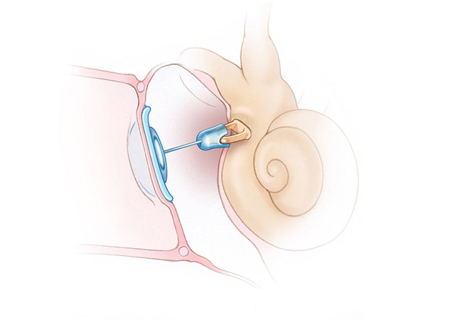Ossicular chair reconstruction.