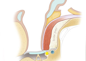 Mastoid obliteration with a combination of musculofascial flap overlying bone paté.