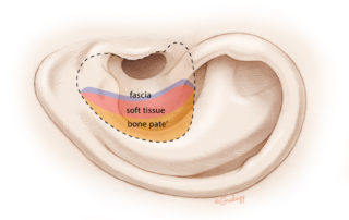 Autologous bone paté may be added to increase the bulk of obliteration.