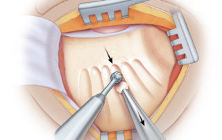 Bone dust is produced with a large cutting burr. Using the burr at slower speed while applying increased tangential pressure to the cortex produces larger, more uniform bone dust particles, which are easily collected. Bone dust collection is typically performed prior to entering the middle ear, and care is taken to avoid entering air cells in order to minimize the risk of collecting epithelial cells or pathogenic bacteria.