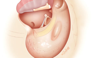 Completed canal wall down mastoidectomy leaving nonpneumatized solid bone in situ.