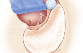 Completed mastoid obliteration using autologous bone dust.