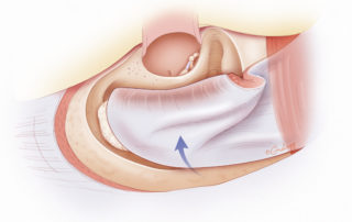 Superiorly based mastoid obliteration flap in place covering underlying bone paté.