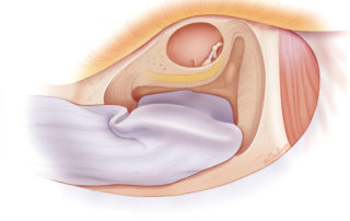 Inferiorly based mastoid obliteration flap with only periosteum.