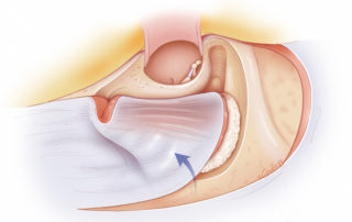 Inferiorly based mastoid obliteration flap with both periosteum and muscle covering bone paté.