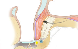 Rotation of a meatally based mastoid obliteration flap covering bone paté to fill the defect.