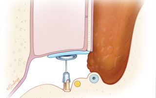 Schematic of a mastoid obliteration flap following intact canal wall mastoidectomy.