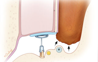 Mastoid obliteration flap retraction.