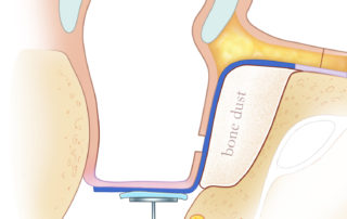 Cross-sectional view of autologous bone dust obliteration of the mastoid to reduce the size of the cavity. Note the large piece of fascia completely covering the bone paté (dust).