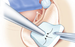 The bone dust is packed tightly by suctioning excess fluid through a cottonoid pledget.