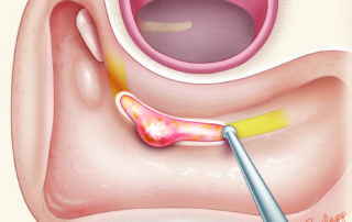 Decompression of the fallopian canal proximal and distal to a swollen nerve at the site of injury.