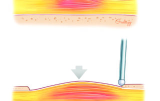 Decompression of an injured nerve.