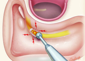 Swipe injury of the facial nerve at the second genu with a cutting burr. This is the classic location of injury sustained during mastoid surgery.