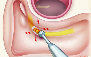 Swipe injury of the facial nerve at the second genu with a cutting burr. This is the classic location of injury sustained during mastoid surgery.