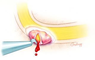 Incising epineurium to release intraneural hematoma.