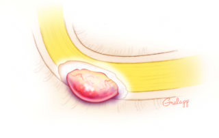 A swollen, herniated nerve following drill injury.