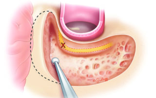 Failing to locate the tegmen can lead to drilling too inferior, thus placing the second genu of the facial nerve at risk.