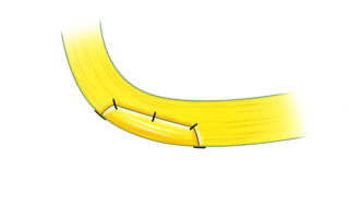 Grafting of a partial injury.