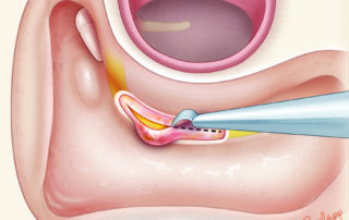 Incising the sheath to relieve compression is controversial and many prefer to leave epineurium intact to preserve vascular supply to the nerve.
