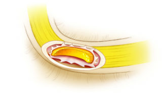 A partial injury due to swipe with a cutting burr.