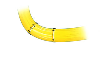 Cable grafting of a transection injury. When the nerve is laid into the fallopian canal, only a couple of epineurial stitches are needed. Some would repair with tissue glue rather than sutures.