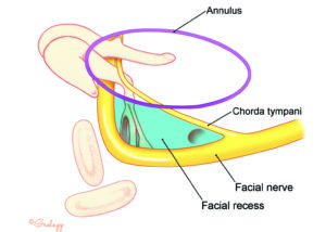 Schematic representation of the relationships of the facial recess and the middle ear exposure afforded by its opening (blue).
