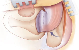 Temporal periosteal flap rotated to cover the middle fossa floor dural exposure. Temporal periosteal flap rotated to cover the middle fossa floor dural exposure.