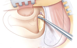 Repair of tegmen dehiscence with autologous bone dust covering the dural defect. In small defects, bone dust covered by a piece of fascia is usually sufficient. In larger defects, reinforcement with a rotation flap may be needed. Note the outline of the temporal periosteal flap. Repair of tegmen dehiscence with autologous bone dust covering the dural defect. In small defects, bone dust covered by a piece of fascia is usually sufficient. In larger defects, reinforcement with a rotation flap may be needed. Note the outline of the temporal periosteal flap.