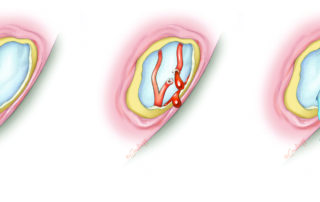 If bleeding occurs from exposed dura, it is best to control with an absorbable gelatin sponge – adrenalin pledget and avoid electrocautery which might disrupt the dura. Cerebrospinal fluid leakage necessitates repair. This can be achieved from below if minor and easily controlled or from above (extradural middle fossa craniotomy) if the injury is large or leakage is difficult to control from below. If bleeding occurs from exposed dura, it is best to control with an absorbable gelatin sponge – adrenalin pledget and avoid electrocautery which might disrupt the dura. Cerebrospinal fluid leakage necessitates repair. This can be achieved from below if minor and easily controlled or from above (extradural middle fossa craniotomy) if the injury is large or leakage is difficult to control from below.