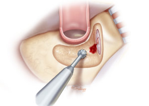 Dural injury due to use of a cutting burr. A rough-cut diamond burr works well in exposing the tegmen and is less likely to cause dural injury.