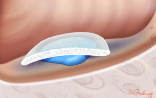 Sigmoid sinus hemorrhage is readily controllable with hemostatic packing. The author uses Floseal covered by Surgicel, which are held firmly under a cottonoid patty over the rent for a few minutes while hemostasis is obtained. This is a routine procedure in operative neurotology, but is seldom necessary in routine otological surgery. Sigmoid sinus hemorrhage is readily controllable with hemostatic packing. The author uses Floseal covered by Surgicel, which are held firmly under a cottonoid patty over the rent for a few minutes while hemostasis is obtained. This is a routine procedure in operative neurotology, but is seldom necessary in routine otological surgery.