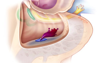 Sigmoid sinus hemorrhage in mastoid surgery is not common, but the otological surgeon must know how to manage it. Sigmoid sinus hemorrhage in mastoid surgery is not common, but the otological surgeon must know how to manage it.