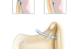 Exposure of tegmen dura is common in cholesteatoma surgery due to either disease erosion or drill exposure. In the vast majority of cases, the dura remains intact. If bleeding occurs, it is best to use absorbable gelatin sponge adrenalin and avoid electrocautery which might disrupt the dura. CSF leakage necessitates repair. Exposure of tegmen dura is common in cholesteatoma surgery due to either disease erosion or drill exposure. In the vast majority of cases, the dura remains intact. If bleeding occurs, it is best to use absorbable gelatin sponge adrenalin and avoid electrocautery which might disrupt the dura. CSF leakage necessitates repair.