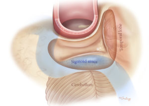 Poorly pneumatized mastoid with low temporal dura and forward sigmoid sinus. This constrains the size of the mastoid cavity.