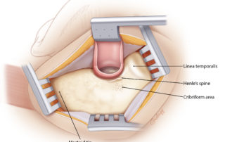 Exposure of the mastoid in preparation for mastoidectomy. Note the surface landmarks.