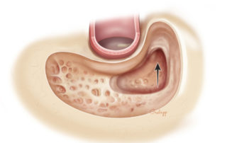 Further opening of the antrum brings the lateral semicircular canal into view.