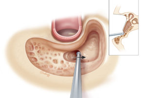 Initial entry into the mastoid antrum.