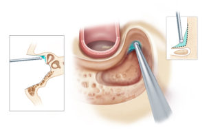 Thinning of the bony shelf over the ossicles in the epitympanum.