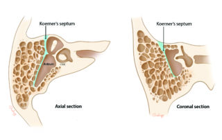 Koerner’s septum needs to be penetrated to enter the antrum.