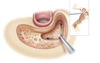 The safest way to approach the antrum is high up along the tegmen and forward toward the epitympanum. The floor of the opening at this stage sometimes is a flat sheet of bone, called Koerner’s septum, which is a false bottom and not the actual floor of the antrum.
