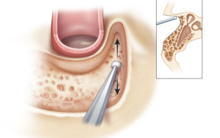 As a general principle, the deepest bone excavation is always kept high and forward approaching the tegmen mastoideum and toward the epitympanum. This is the surest way of encountering the antrum and avoiding possible injury to the facial nerve at its second genu.