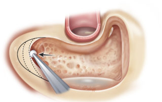 Tip cells are opened as necessitated by the extent of pneumatization.