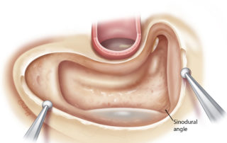 Beveling of the edges of the mastoid is important to avoid sharp edges which may cause discomfort, especially in eyeglass wearers.