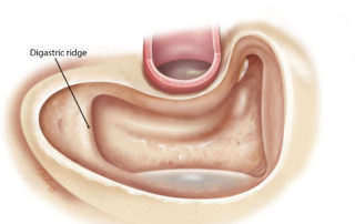 Completed mastoidectomy. Completion of the tip cell removal has exposed the digastric ridge.