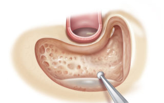 Thinning of air cells over the sigmoid sinus and the sinodural angle (also known as Citelli’s angle).