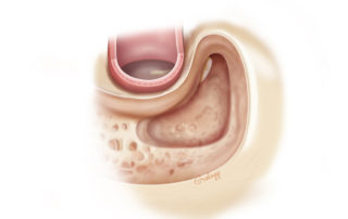 Completion of the antrotomy and exposure of the epitympanum including the body of the incus and the head of the malleus. Note that the opening anteriorly fully exposes the head of the malleus and the anterior epitympanum.