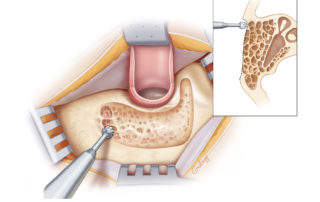 Removal of the outer cortex reveals the peripheral air cell system in the well pneumatized temporal bone.